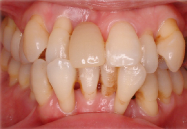 メタルセラミック症例