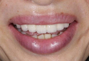 メタルセラミック症例